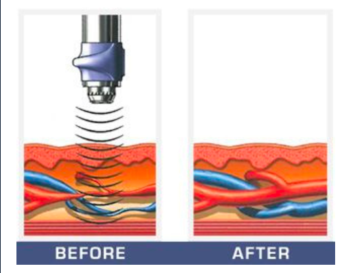 Before and after treatment of Shockwave therapy and the impact of Blood Flow and Blood Vessel Growth